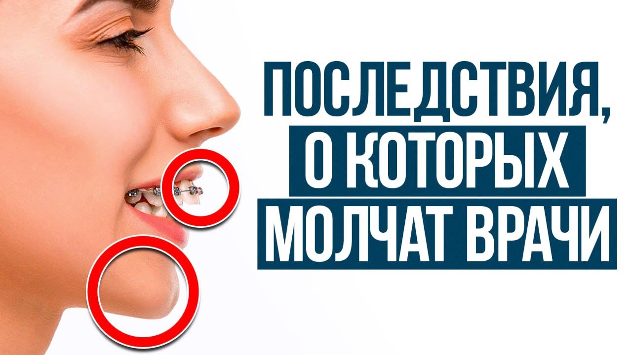 Брекеты МЕНЯЮТ лицо и тело! / Как СДЕЛАТЬ зубы ровными, а прикус правильным, сохраняя здоровье?