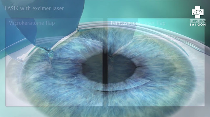 So sánh femto fasik và lasik thông thường năm 2024