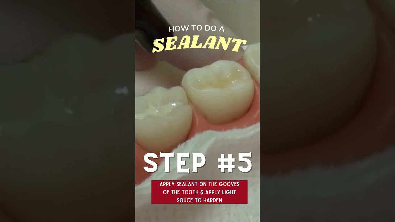 Sealant Procedure: Apply and Harden the Sealant | In Office to Hands On Dental Training