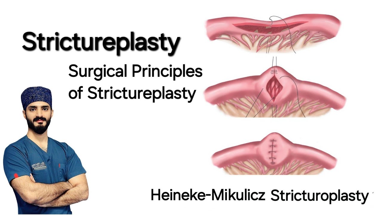 Surgical Principles of Strictureplasty - Dr Tayyab Riaz Ch - YouTube