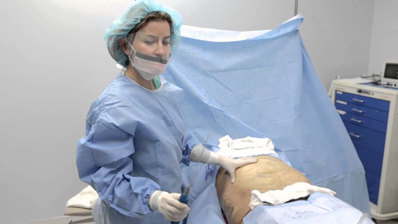 Tumescent Liposculpture Dr. Sabrina Fabi San Diego Dermatology