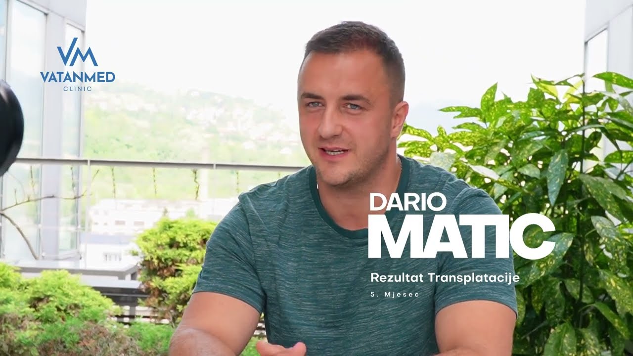 Transplantacija kose VatanMed, iskustva klijenata: Dario Matić o uspješnom zahvatu transplatacije