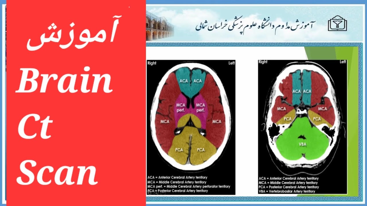 2.بخش دوم آموزش تفسیر brain ct scan سی تی اسکن مغز ، خانم دکتر مهاجر ...