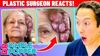 Plastic Surgeon Reacts to DR. PIMPLE POPPER! 100 Masses On Her Head!