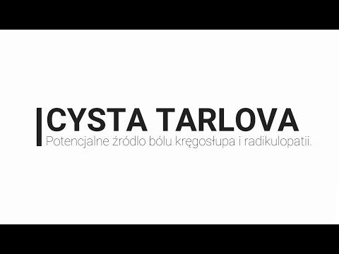 Cysta Tarlova- możliwa przyczyna bólu kręgosłupa i radikulopatii?