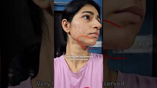 🌞Chemical Peel before-after For Acne #chemicalpeel #shortsviral #skincare #skintransformation #shots