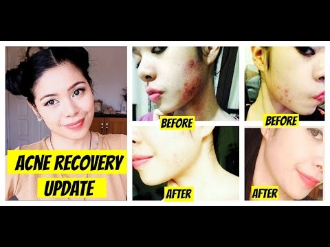 Acne Recovery Update-Hyperpigmentation, Rosacea, Diet and Scars?