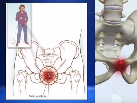 Vídeo: Disfunção Pubiana Da Sínfise: Sintomas, Tratamento, Riscos E Muito Mais