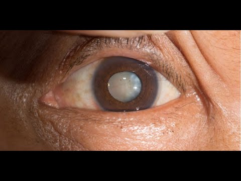 Vídeo: Diabetes Y Sus Ojos: Visión Borrosa Y Otros Problemas