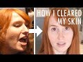 How I cleared my skin