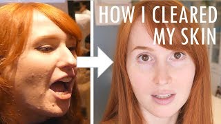 How I cleared my skin