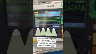 Download Lagu CARA MUDAH MENGINGAT GAMBARAN EKG VT #ekg #emergency #emergencyroom #perawat #ugd #icu #fyp MP3 Download Lagu CARA MUDAH MENGINGAT GAMBARAN EKG VT #ekg #emergency #emergencyroom #perawat #ugd #icu #fyp MP3