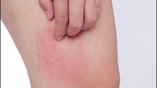 Acupressure points for itching and skin rashes/ allergies screenshot 4