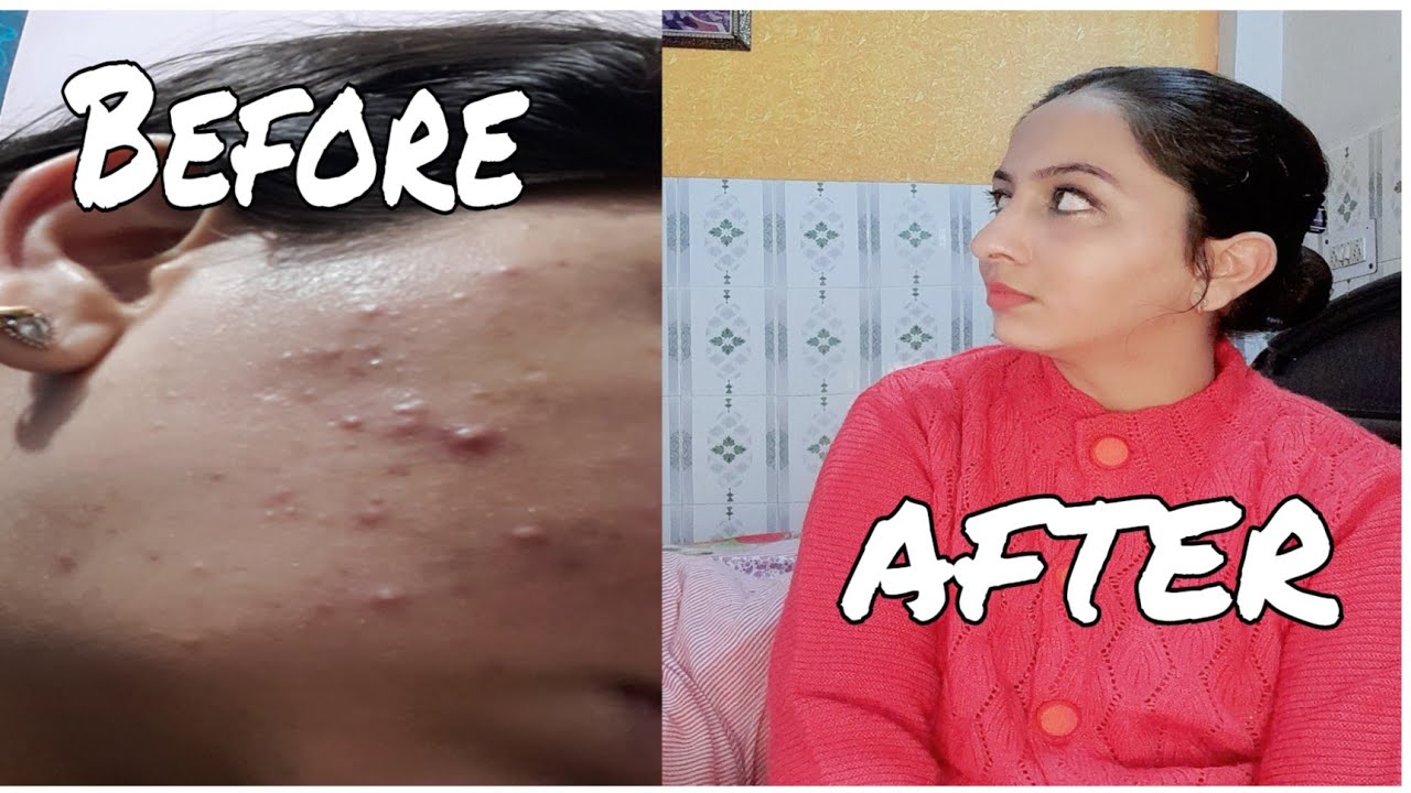 How I cleared My skin from Acne in 2 Months |My Journey From Acne To ...
