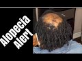 Severe Alopecia | How To Hide Balding | Alopecia Hair / Dread and crochet perfectly done