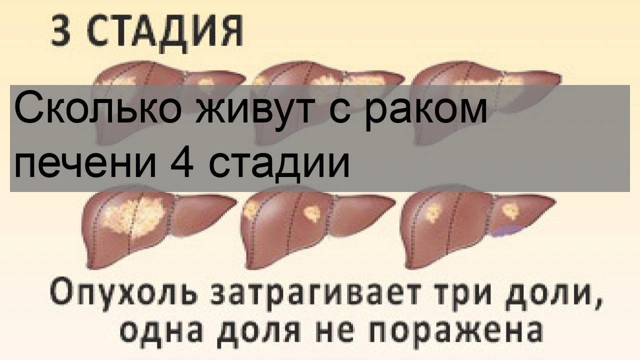 Аденокарцинома печени 4 стадия