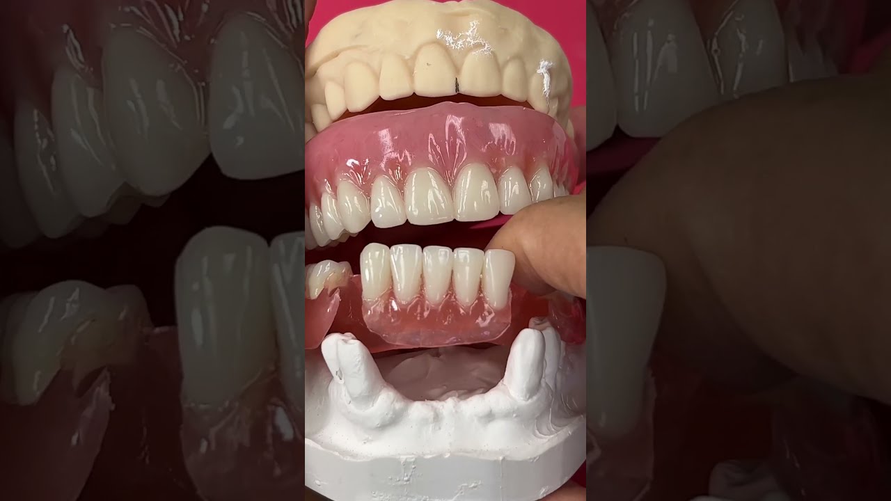 Denture Vs Flexible Partial