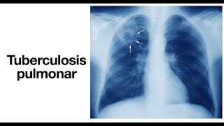 ¿Qué es la tuberculosis? - ¿Cómo se contagia? - Tuberculosis pulmonar - Síntomas y Tratamiento