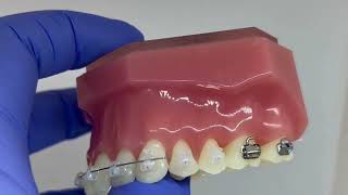 What to do if your wire breaks