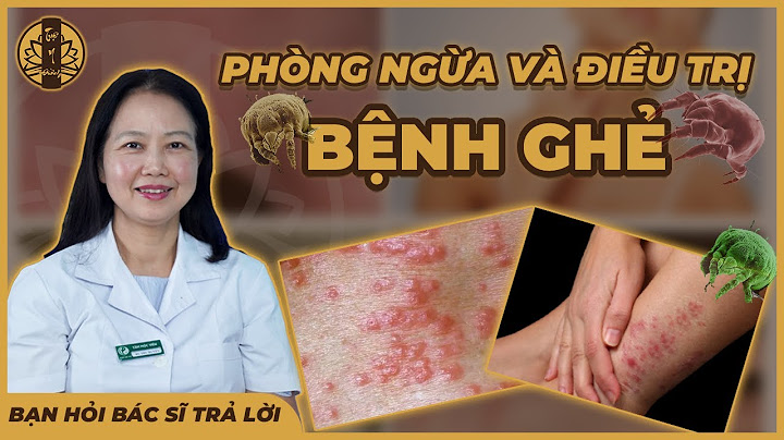 Điều trị bệnh ghẻ trong bao lâu