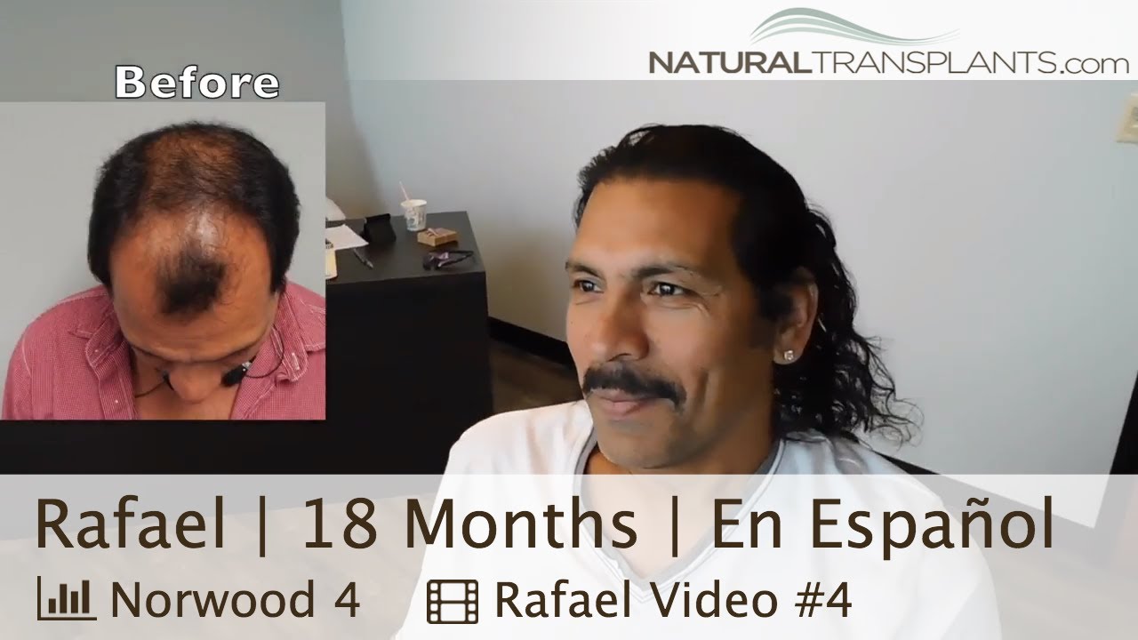 fue hair transplant month by month Trasplante de Pelo en Miami | Transplante de Cabello - En Español (Rafael)