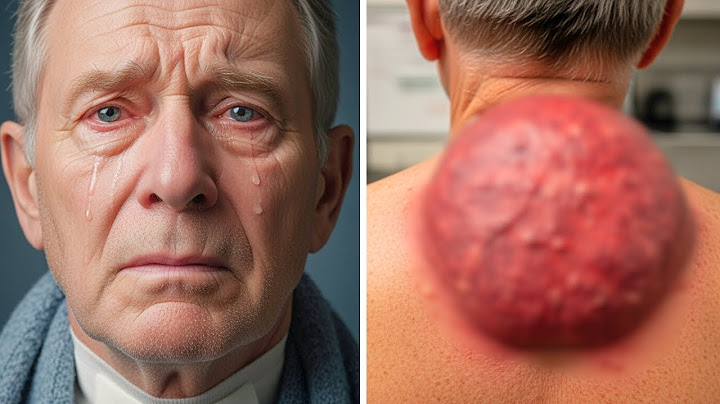 Man Thought It Was Just Fat—Then Doctors Opened His Neck Lump And Froze In Fear!