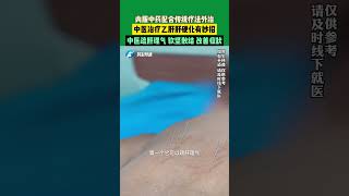 內服中藥配合傳統療法外治，中醫治療乙肝肝硬化有妙招！中醫可疏肝理氣、軟堅散結、改善癥狀。