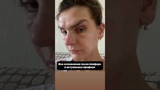 Все осложнения после блефаро в моем тг: doc_isabekov