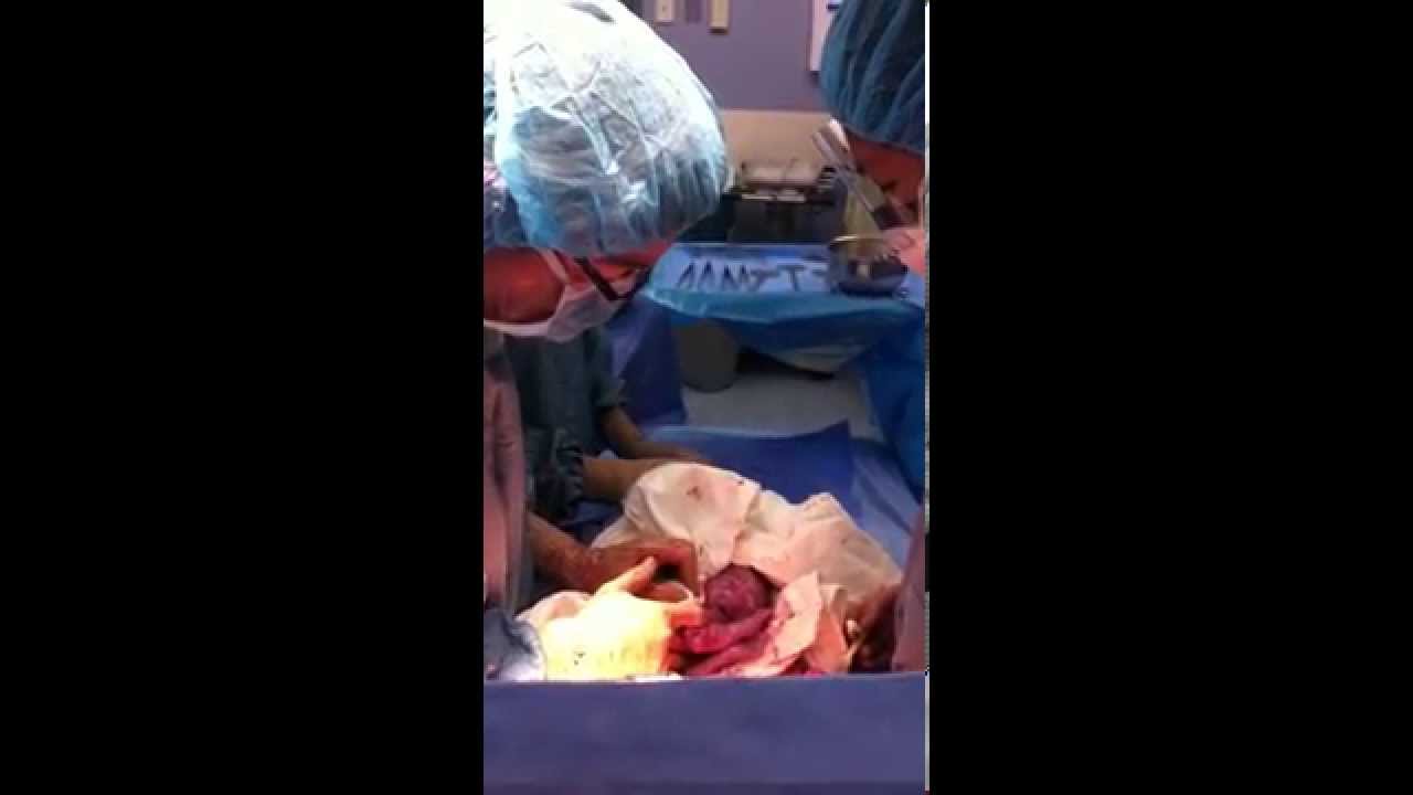 Delayed Cord Clamping During Cesarean Birth Takes A Village