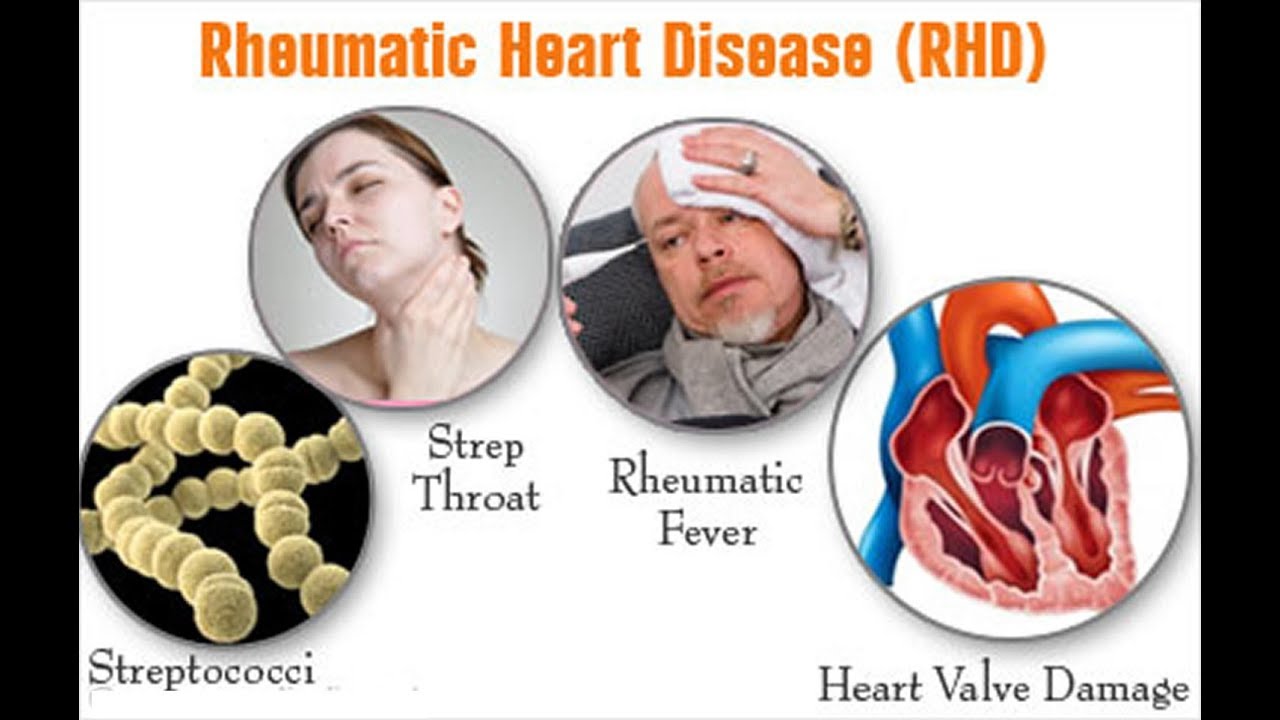 rheumatic heart disease symptoms - YouTube