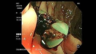 Water-Assisted Colonoscopy with Cyanoacrylate Rescue Therapy for Refractory Radiation Proctopathy