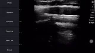 How to install and use the ios software for Youkey D8 wireless pocket ultrasound system screenshot 2