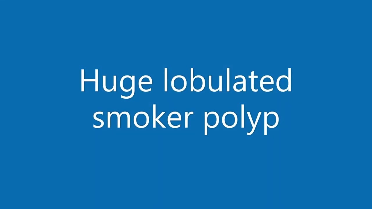 Huge smoker polyp