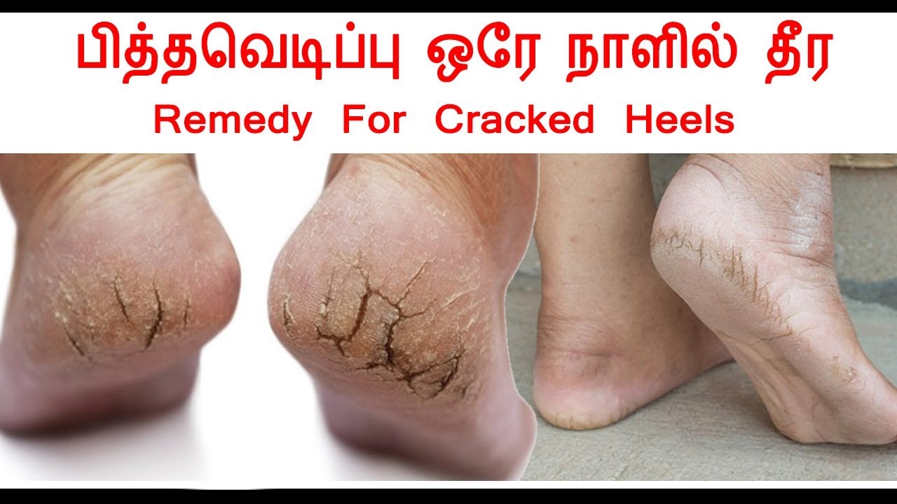 Home Remedy For Cracked Heels or foot crack YouTube