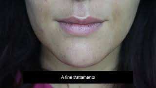 Scrub Labbra Perchè Farlo E Come Farlo.