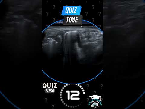 Ultrasound Quiz Challenge - 50: Can You Diagnose This Case?