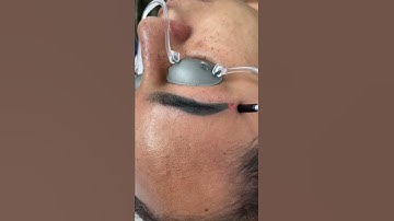 Brow Tattoo Removal