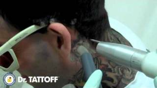 Tattoo Removal Behind Ear - Laser Tattoo Removal in Dallas Texas - Dr Tattoff