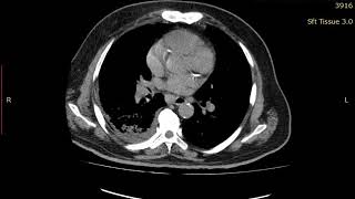 HRCT chest soft tissue screenshot 2