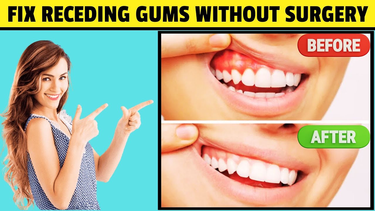 Stop Gum Recession NOW! Natural Ways to Reverse It at Home