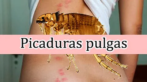 ¿Te picarán las pulgas en la cara?