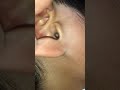 【耳掃除】取れるか？？巨大！！小学１年生の息子のはがし耳垢 #耳垢 #耳掃除 #ear #wax #ピンセット #匠の技 #clean #asmr #耳かき #귀이개 #掏耳勺 #癒し