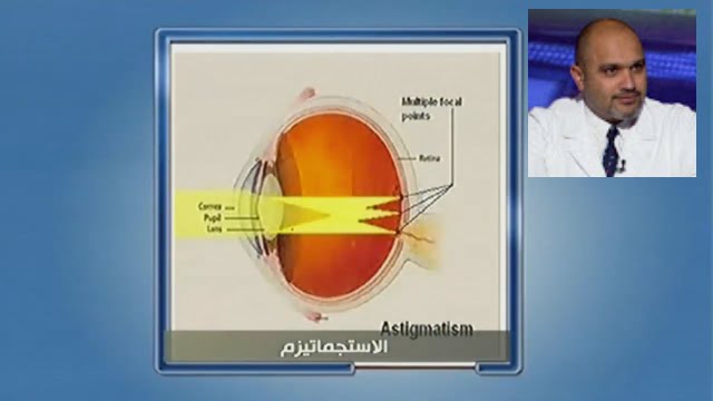الاستجماتيزم astigmatism | دكتور اشرف حسن سليمان