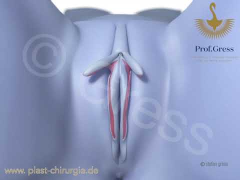 Labiaplasty - Labia minora reduction without correction of clitoral protrusion | Prof. Gress