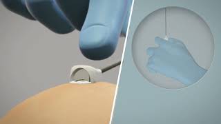 Rocket Medical Copeland Fetal Scalp Electrode