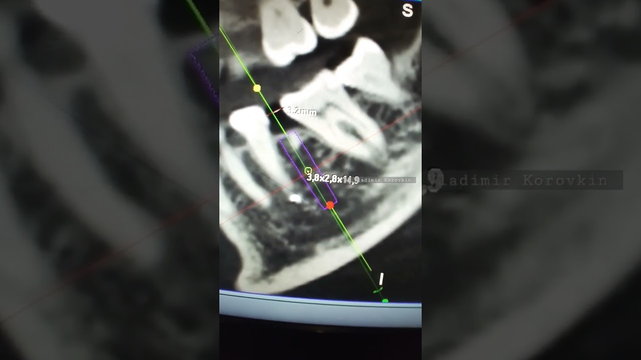 Ситуация когда хочется установить имплантат. Кости много, а места нет.Парадокс в имплантации.#1.