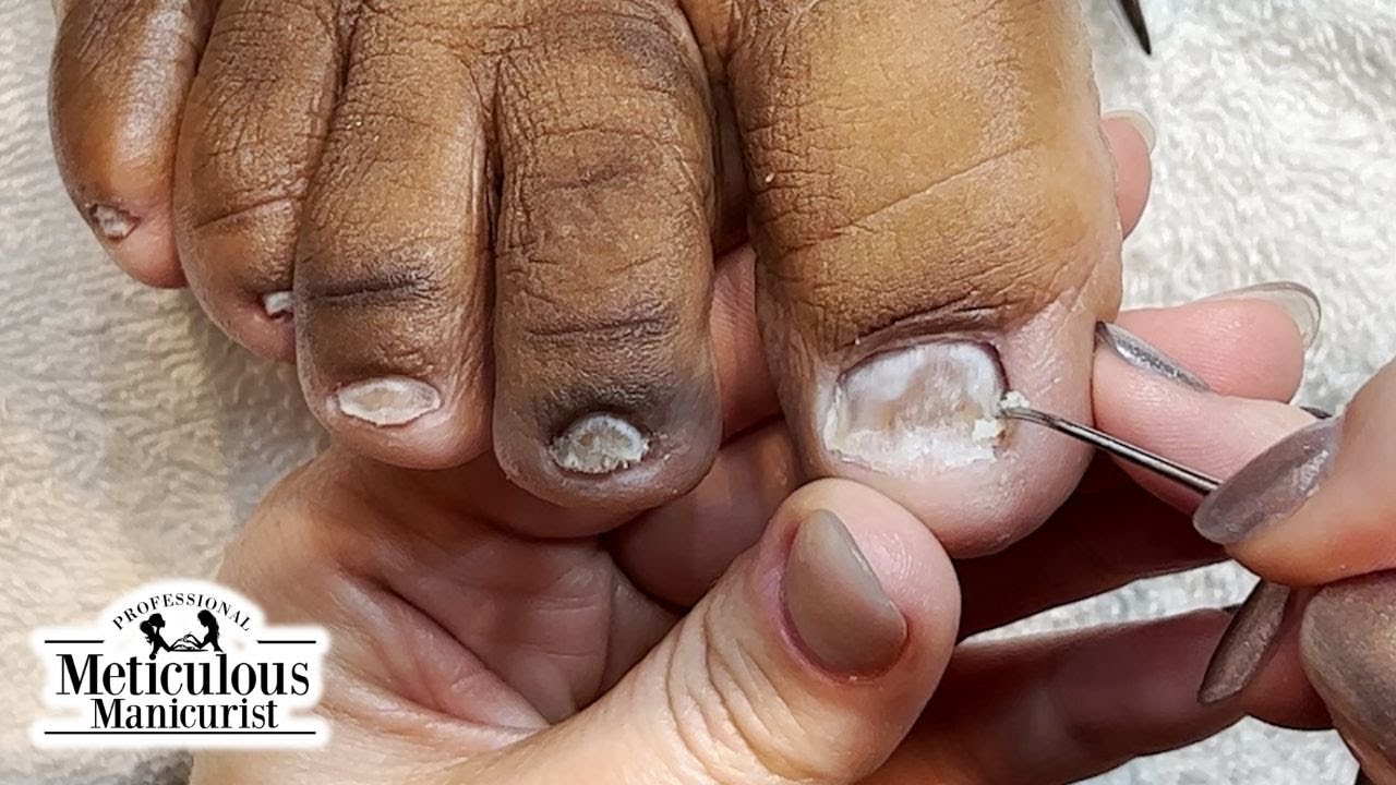 glutathione and toenail fungus Fungus: How It Supports Nail Health Vitamin B12 for Injection