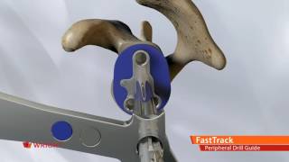 AEQUALIS™ PERFORM™+ Shoulder System_FastTrack Peripheral Drill Guide Animation Stryker Perform Plus Glenoid Augment Back Table Setup