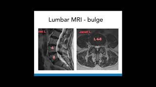 Toxic Annular Tears of the Lumbar Spine