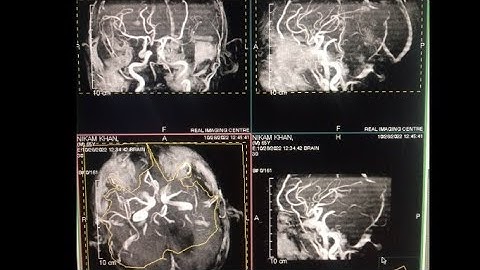 MR angiography (Brain) ||protocol and Technique || 0.3 tesla MRI system